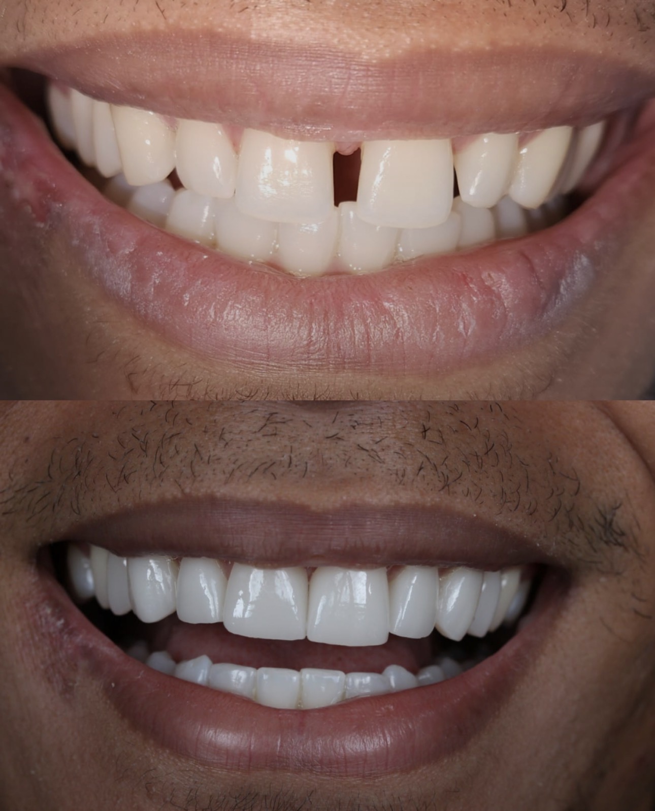 Antes e depois: espaço entre os dentes da frente corrigido com lentes de contato dental