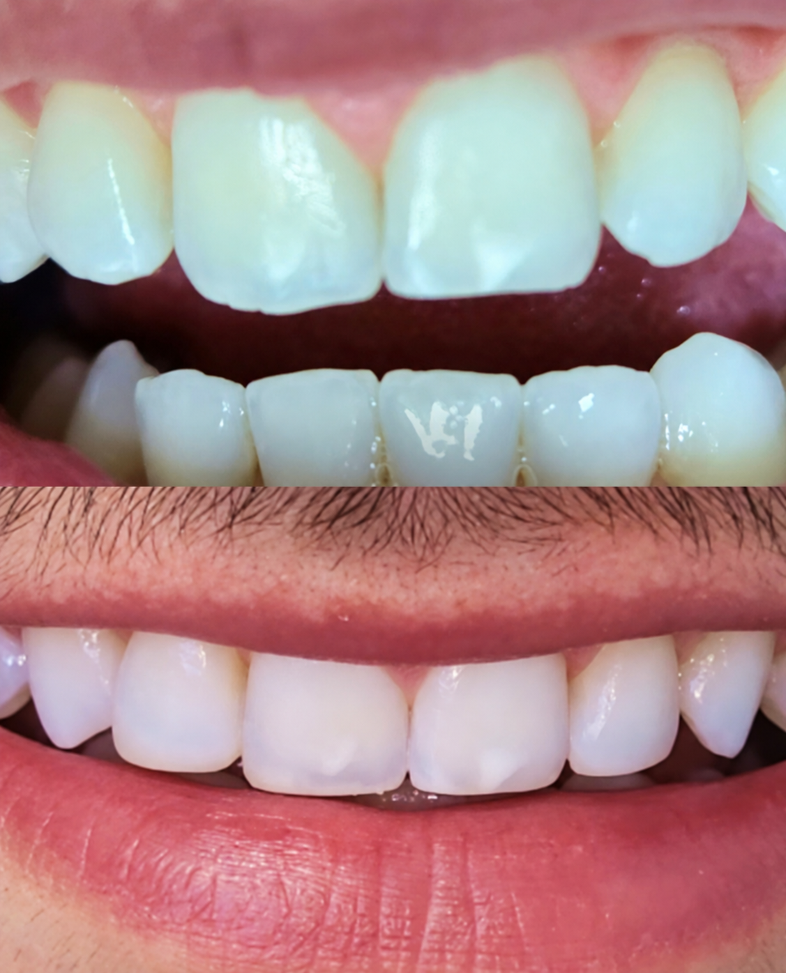 Antes e depois: dentes amarelados e irregulares transformados em sorriso branco e alinhado
